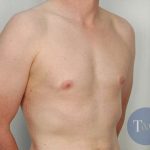 Gynecomastia Before & After Patient #1354