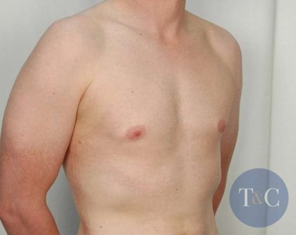 Gynecomastia Before & After Patient #1354