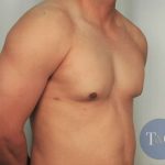 Gynecomastia Before & After Patient #1359