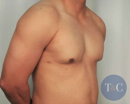 Gynecomastia Before & After Patient #1359