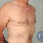 Gynecomastia Before & After Patient #1364
