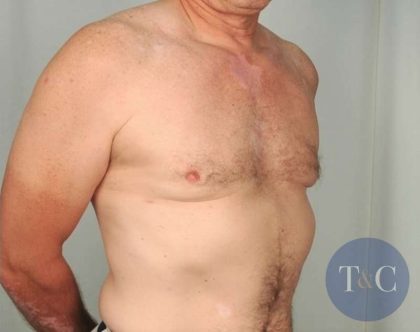Gynecomastia Before & After Patient #1364