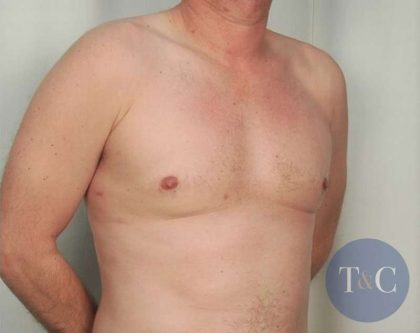Gynecomastia Before & After Patient #1369
