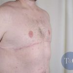Gynecomastia Before & After Patient #1374