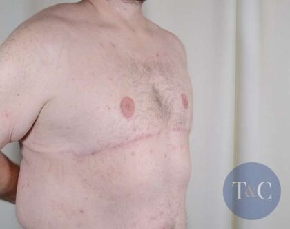 Gynecomastia Before & After Patient #1374