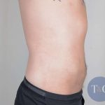 Men's Liposuction Before & After Patient #1379
