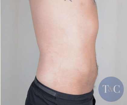 Men's Liposuction Before & After Patient #1379