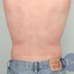 Men's Liposuction Before & After Patient #1384