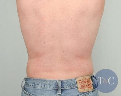 Men's Liposuction Before & After Patient #1384