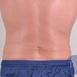 Men's Liposuction Before & After Patient #1389