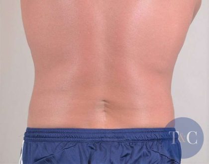 Men's Liposuction Before & After Patient #1389