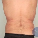 Men's Liposuction Before & After Patient #1396
