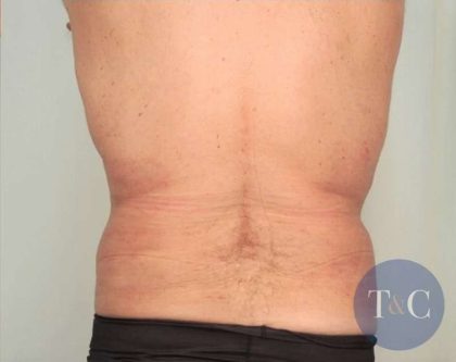 Men's Liposuction Before & After Patient #1396