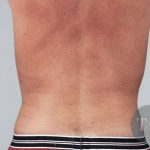 Men's Liposuction Before & After Patient #1401