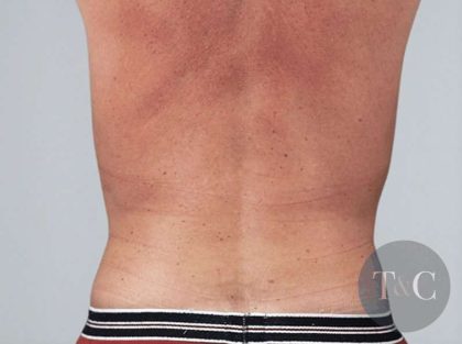 Men's Liposuction Before & After Patient #1401