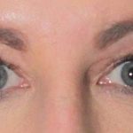 Eye Lift Before & After Patient #1408