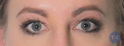 Eye Lift Before & After Patient #1408