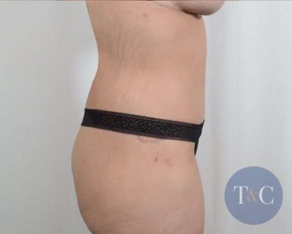 Tummy Tuck Before & After Patient #201
