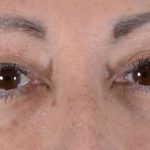 Eye Lift Before & After Patient #1411