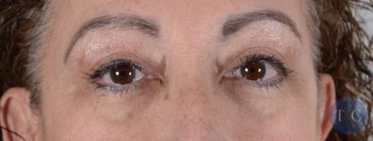Eye Lift Before & After Patient #1411