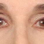 Eye Lift Before & After Patient #1414