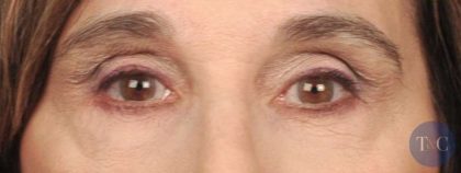 Eye Lift Before & After Patient #1414