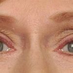 Eye Lift Before & After Patient #1417