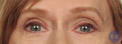 Eye Lift Before & After Patient #1417
