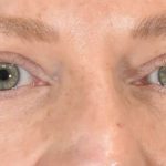 Eye Lift Before & After Patient #1420