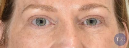 Eye Lift Before & After Patient #1420