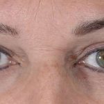 Eye Lift Before & After Patient #1423