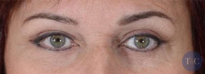 Eye Lift Before & After Patient #1423