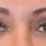 Eye Lift Before & After Patient #1426