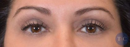 Eye Lift Before & After Patient #1426