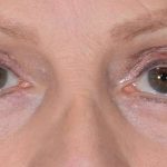 Eye Lift Before & After Patient #1429