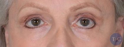 Eye Lift Before & After Patient #1429