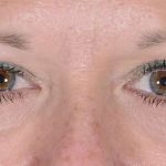 Eye Lift Before & After Patient #1432