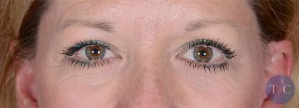 Eye Lift Before & After Patient #1432