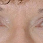 Eye Lift Before & After Patient #1435