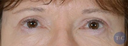 Eye Lift Before & After Patient #1435