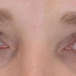 Eye Lift Before & After Patient #1438