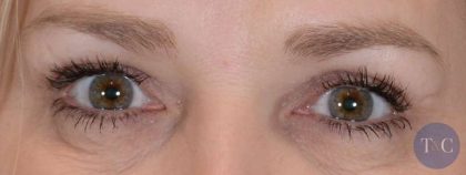 Eye Lift Before & After Patient #1438