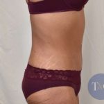Tummy Tuck Before & After Patient #206