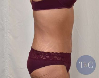 Tummy Tuck Before & After Patient #206