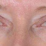 Eye Lift Before & After Patient #1441