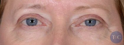 Eye Lift Before & After Patient #1441