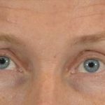 Men's Eye Lift Before & After Patient #1444