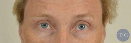Men's Eye Lift Before & After Patient #1444