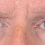 Men's Eye Lift Before & After Patient #1447