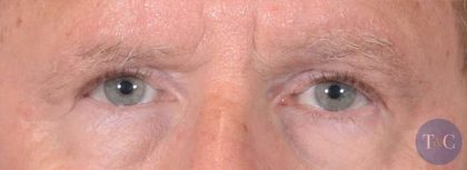 Men's Eye Lift Before & After Patient #1447